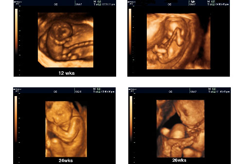 3D 4D Ultrasound Pic 3 - Personalized Women's Healthcare
